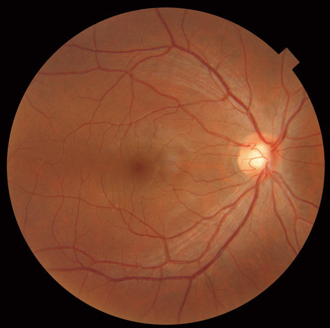 2D image of the back of the eye
