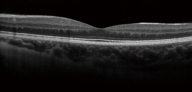 3D image of the macula