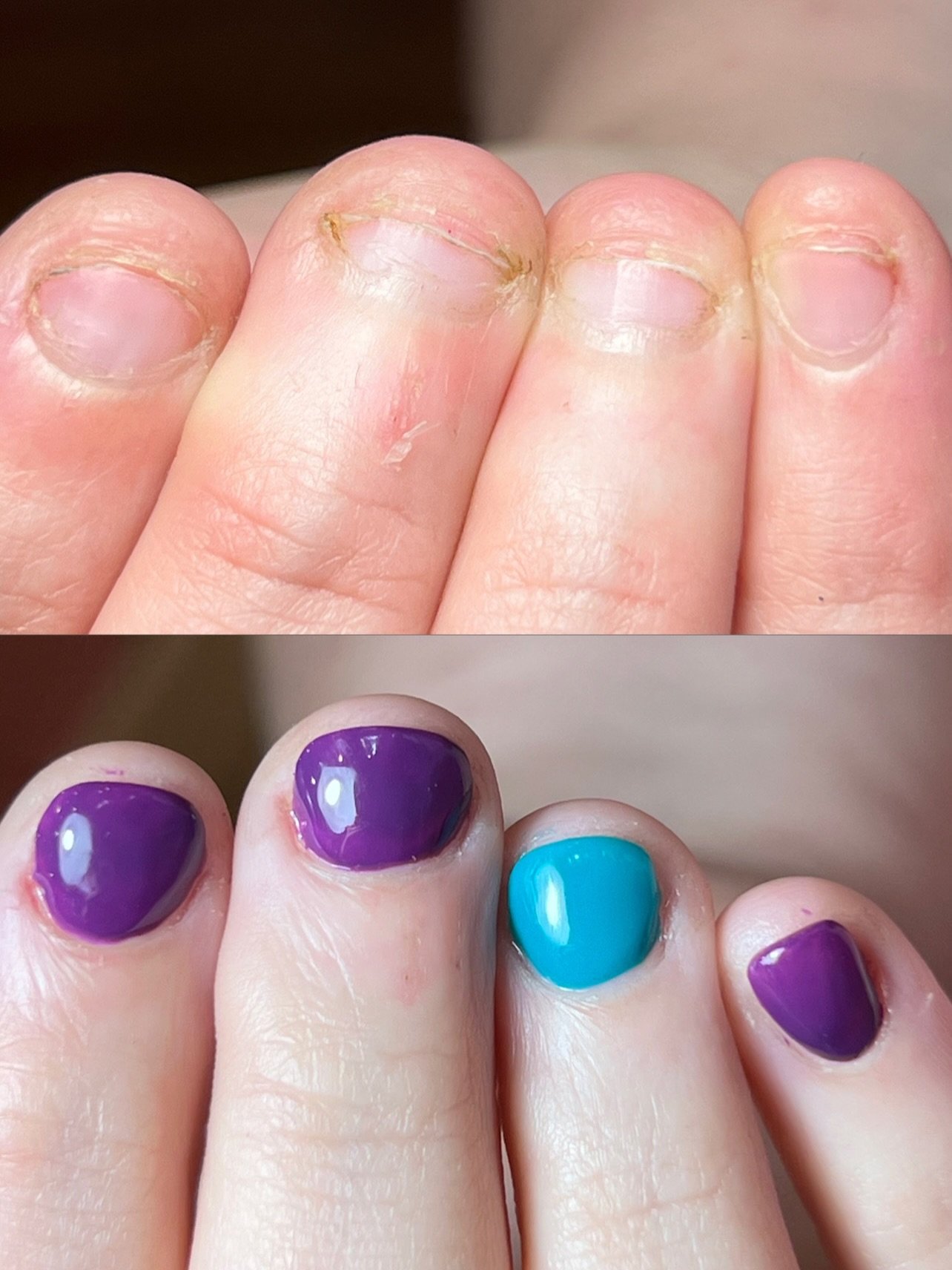 We're here for the short, the bitten, the picked and the nibbled. If you've ever felt your nails are too bitten to be beautiful, you're wrong. 
Book your nail biting recovery service with us!
Above is 3 before and after photos of each hand and thumbs