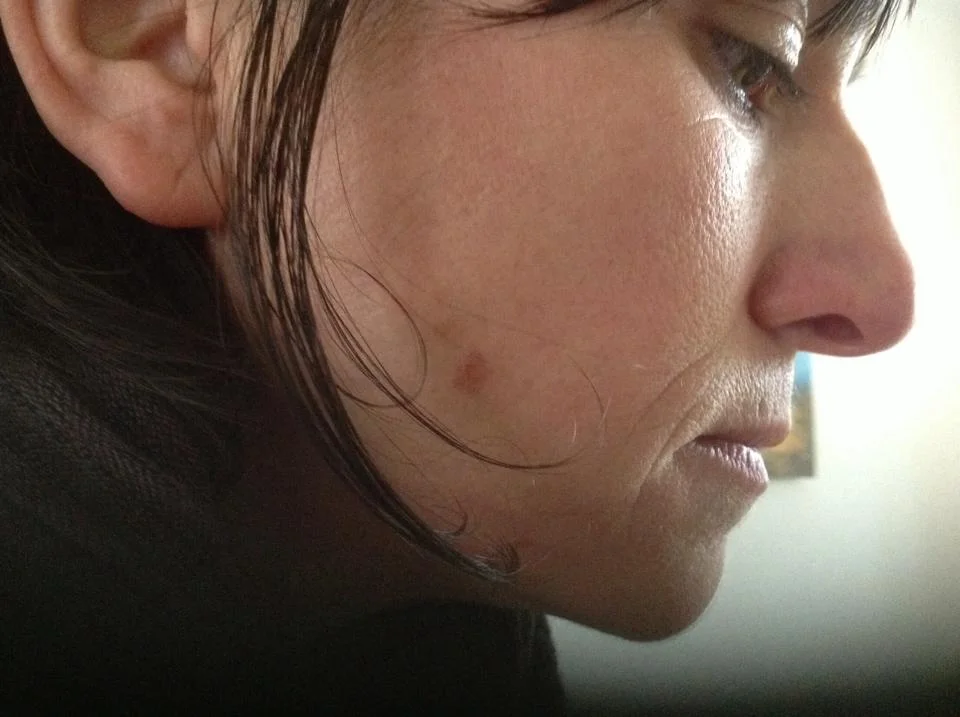 This was week two of diet change and after multiple daily applications of the cream.