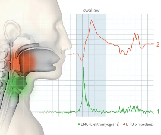 RehaIngest uses BOTH EMG and bioimpedence to accurately detect each swallow
