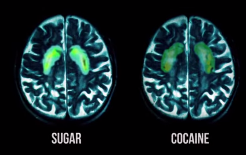 sugar-cocaine-brain.jpg
