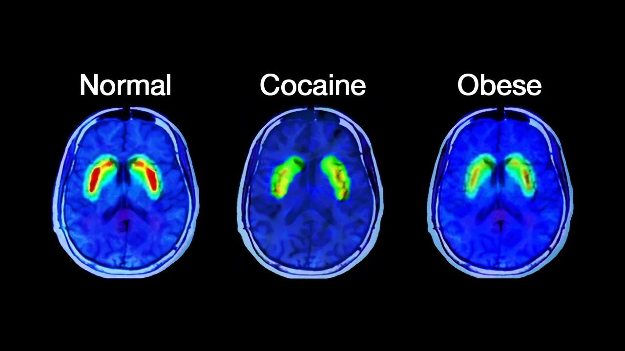 normal-cocaine-obese-brain.jpg