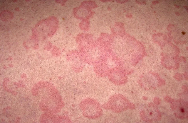 Urticaria