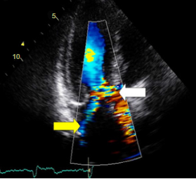 TTE in apical view with color-flow Doppler with turbulent flow in the left ventricular outflow tract (white arrow) and mitral regurgitation (yellow arrow) because of mitral valve systolic anterior motion.