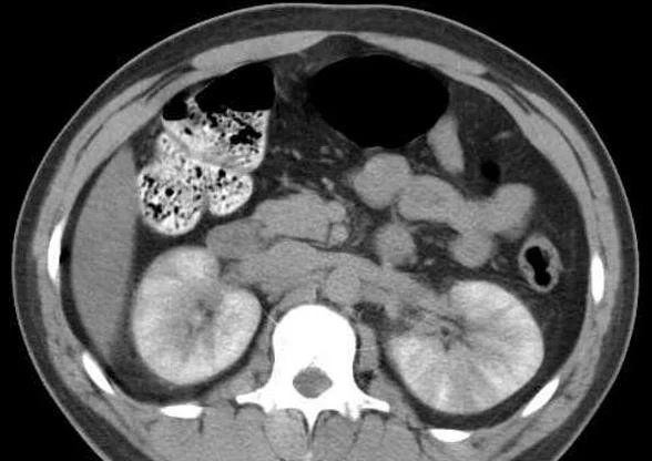 "Striated Nephrogram" - notice the striped pattern on the kidneys. Reference: radiopaedia.org