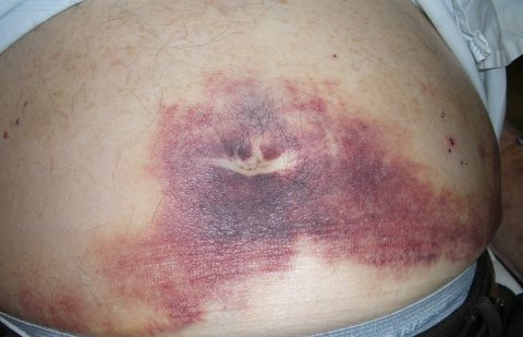 Cullen's sign, ecchymosis in the subcutaneous fat around the umbilicus, which isassociated with Grey-Turner's sign (bruising on the flanks). This can indicate pancreatic necrosis with retroperitoneal bleeding.