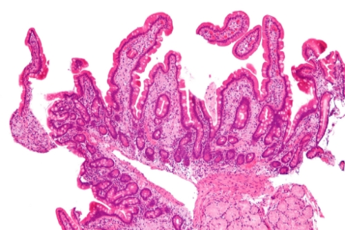Intestinal histology with PAS + foamy macrophages found in Whipple's disease