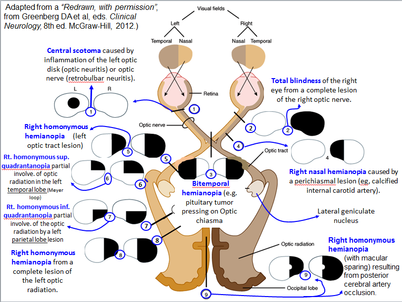 Thanks to Dr. Hunter for this wonderful summary of the visual pathway with correlations between the location of the lesion and the type of visual field cut.