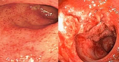 GVHD Colitis (Left); CMV Colitis (Right)