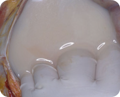 An example of what lymphatic leakage may look like from a body cavity.