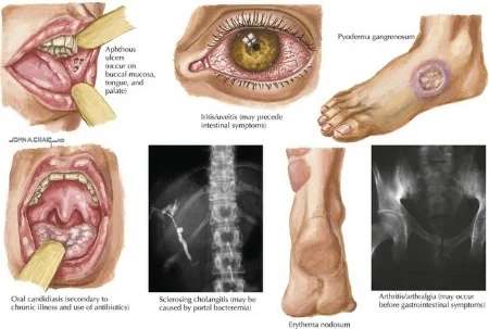 Some extraintestinal manifestations of IBD