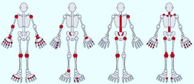 Patterns of polyarthritis. Can you identify the most likely diagnosis based on these distributions? (answers below)