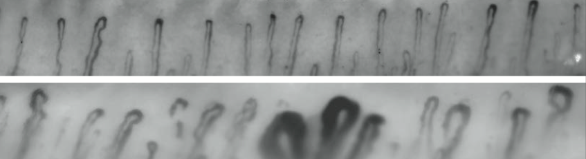 Nailfold capillary microscopy can be performed with application of oil to the periungual area and examination with an ophthalomoscope or a dermatoscope. Top: normal nailfold capillaries. Bottom: abnormal with enlarged capillary loops typical of microvascular disease.