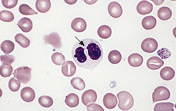 A neutrophil with pseudo-Pelger-Huet nucleus (aka "Aviator nucleus" per Dr. Lachowiez given it's sunglasses appearance) with decreased lobes that are connected by a thin strand giving a "pince-nez" appearance. This neutrophil also has markedly reduced granulation, a finding commonly seen in MDS.