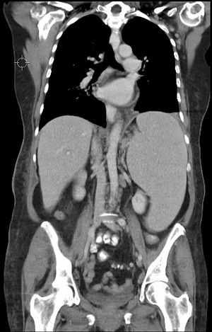 Massive splenomegaly. 