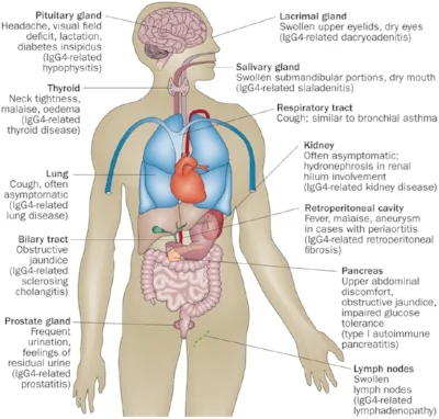 Clinical manifestations of IgG-4 related disease. 