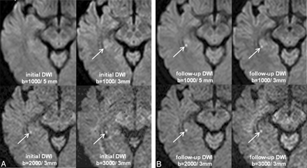 Diffusion-weighted imaging can depict small punctate hyperintense lesions in the hippocampus in transient global amnesia (TGA).