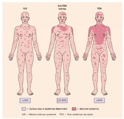 Pictural-representation-of-SJS-SJS-TEN-overlap-and-TEN-showing-the-surface-of-epidermal.png.jpeg