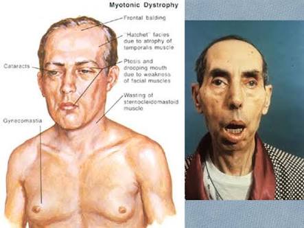 An example of "Hatchet Facies" due to temporalis muscle atrophy.