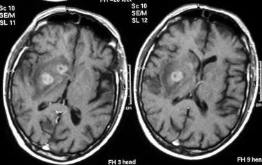 Ring-enhancing Toxoplasma