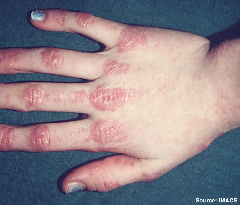 Gottron's Papules