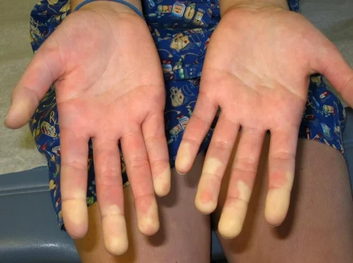 Courtesy Medscape