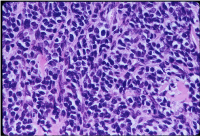 Sheet of “small round blue cells”