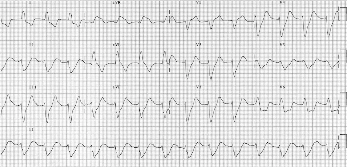 Yikes! He had a normal EKG prior. Let’s point out some of the scary changes here: 1. Where are the P waves? are they gone entirely or just very small? 2. Are those T waves peaked? 3. Why is the QRS suddenly so wide?
