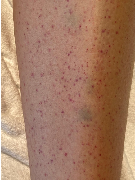 Petechiae: A Review — IMRESPDX