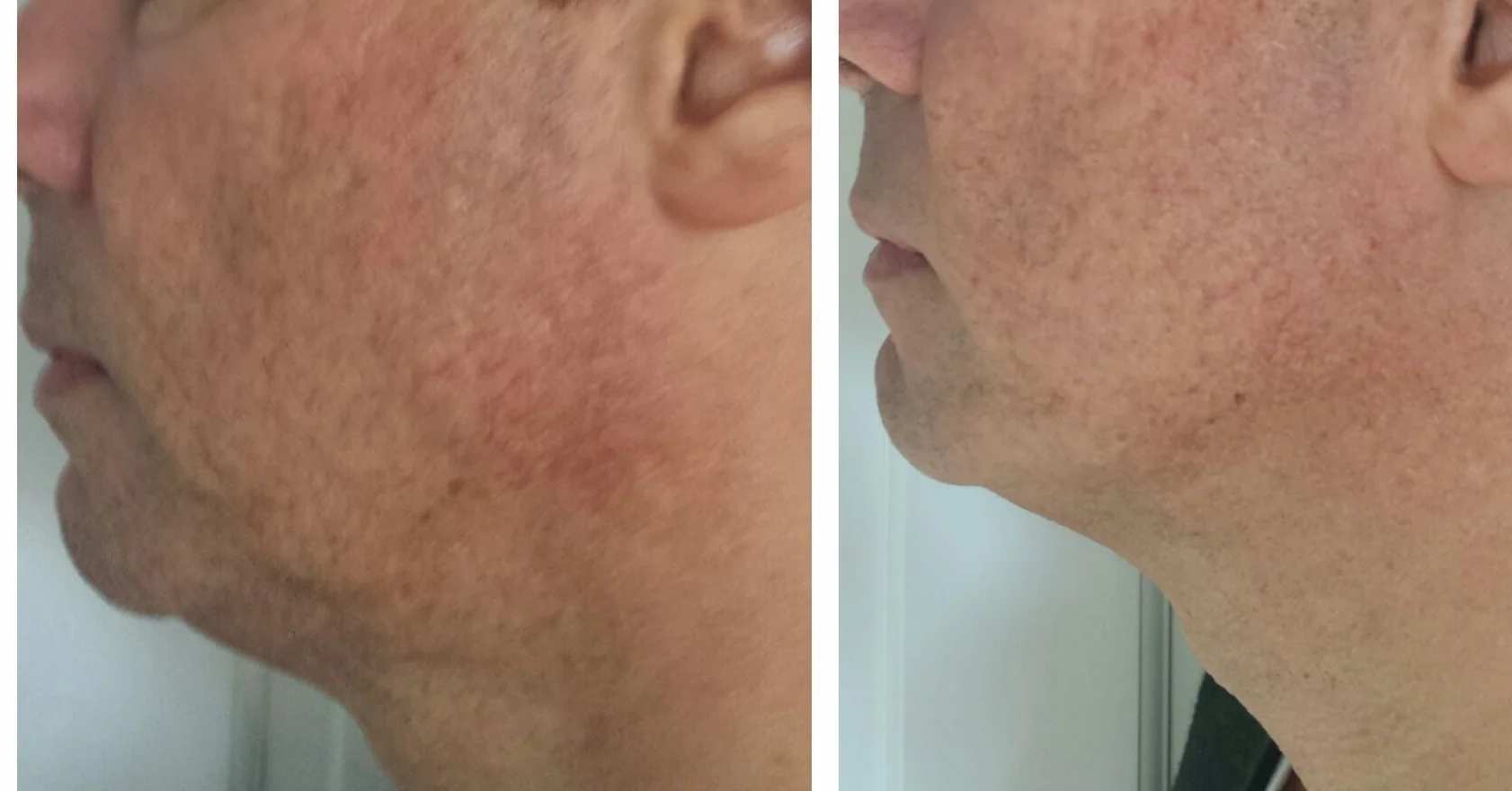 4 Treatments