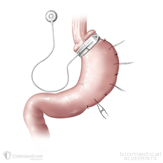 Lap-band Surgery