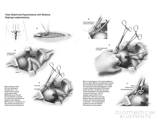 Total Hysterectomy