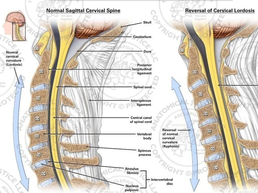S10069_norm_vs_rev_cerv_lordosis_sag.jpg