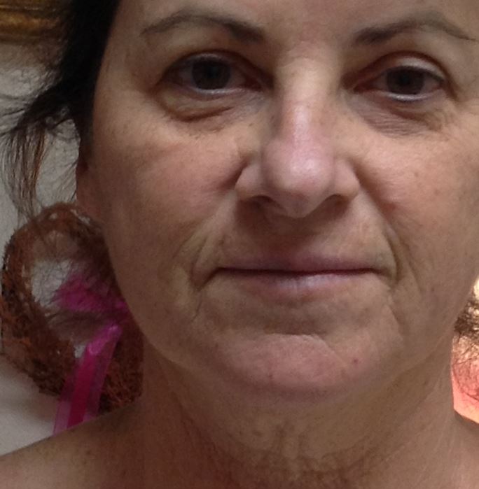 Cosmetic Rejuvenation - Before