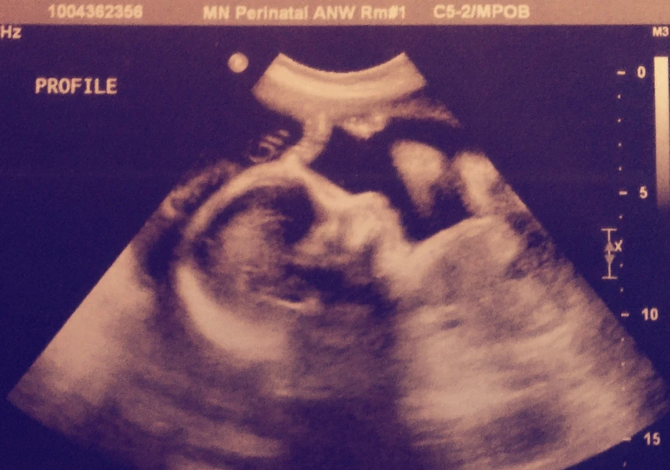 Natalie in the womb.jpeg