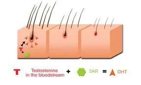 The Progesterone and Hair Loss Connection