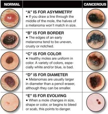Skin Cancer on the Rise in Young Women