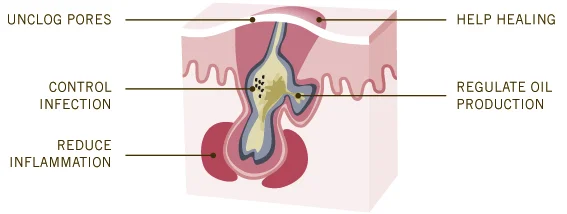 Acne + Bacteria.  Resolve pesky pimples it at any age! 