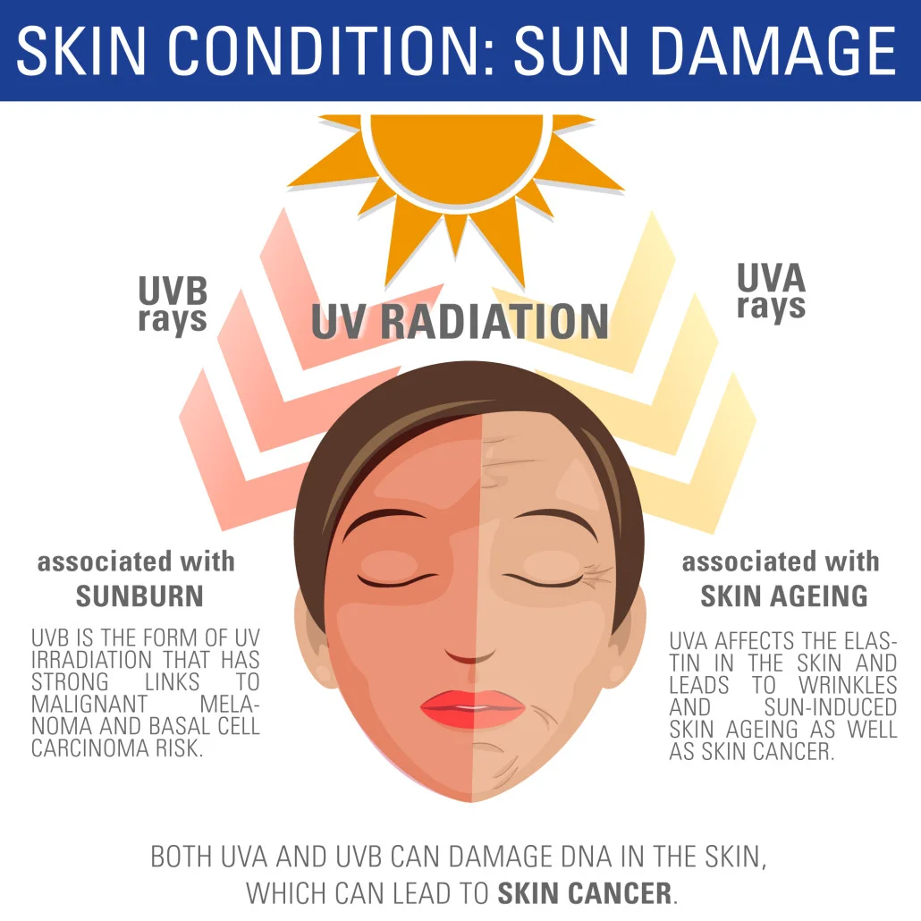 Info-SUN-DAMAGE-box-1030x1030.jpg