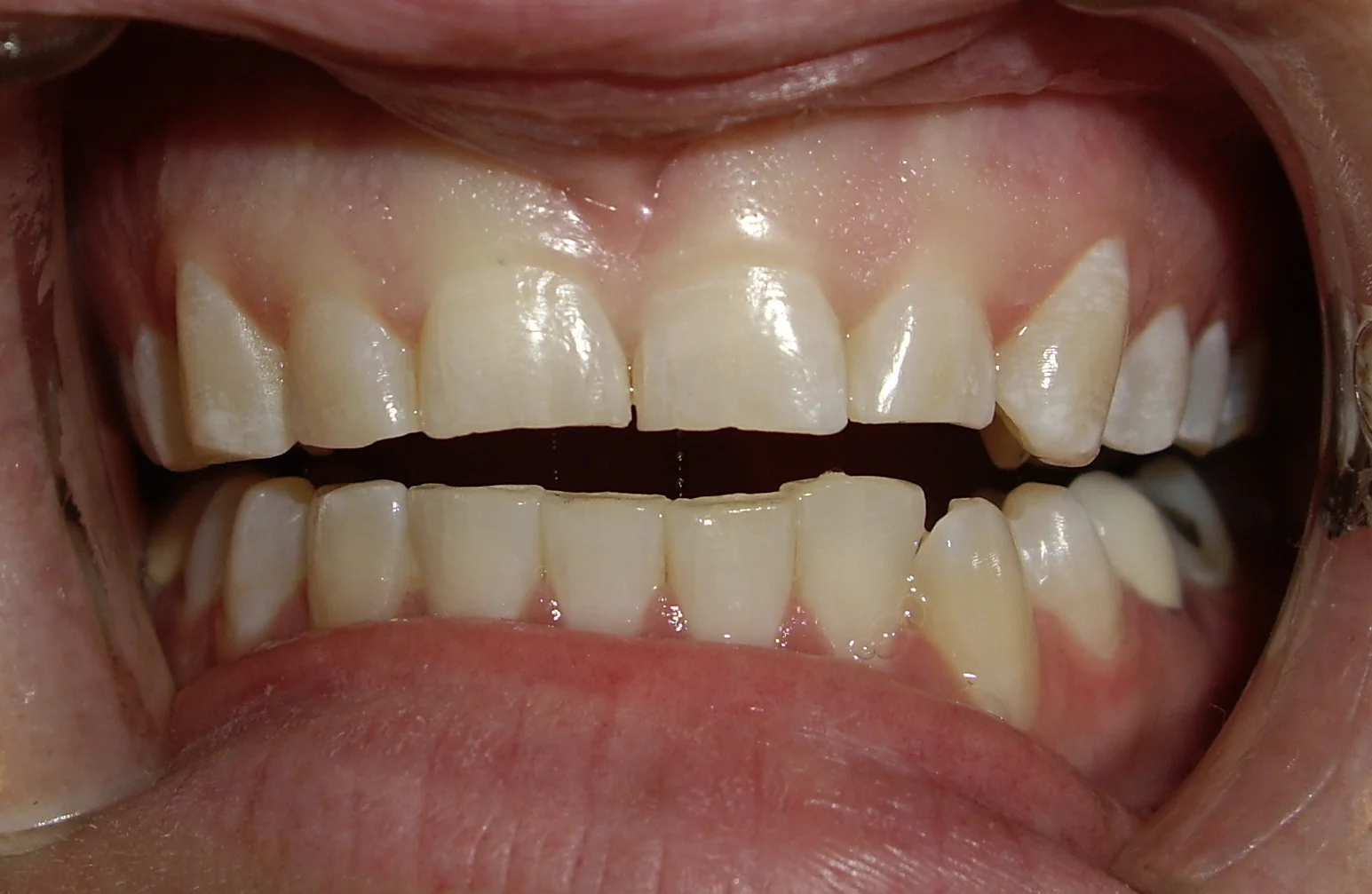 Before treatment Young female with chronic history of bruxism (teeth grinding). She had significant wear on her maxillary incisors and canines. Her main concern was regaining her full smile for her wedding.