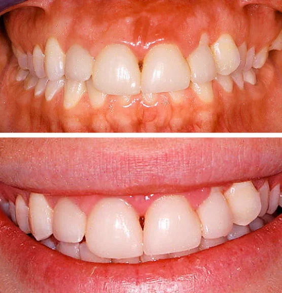 Before treatment Patient presented with unusual gum recession upper left incisor that was undesirable to the patient. Also, the patient’s previous crowns were low and not in line with her other teeth. She wanted to address both the gum recession and the asymmetrical crowns on her top four teeth.