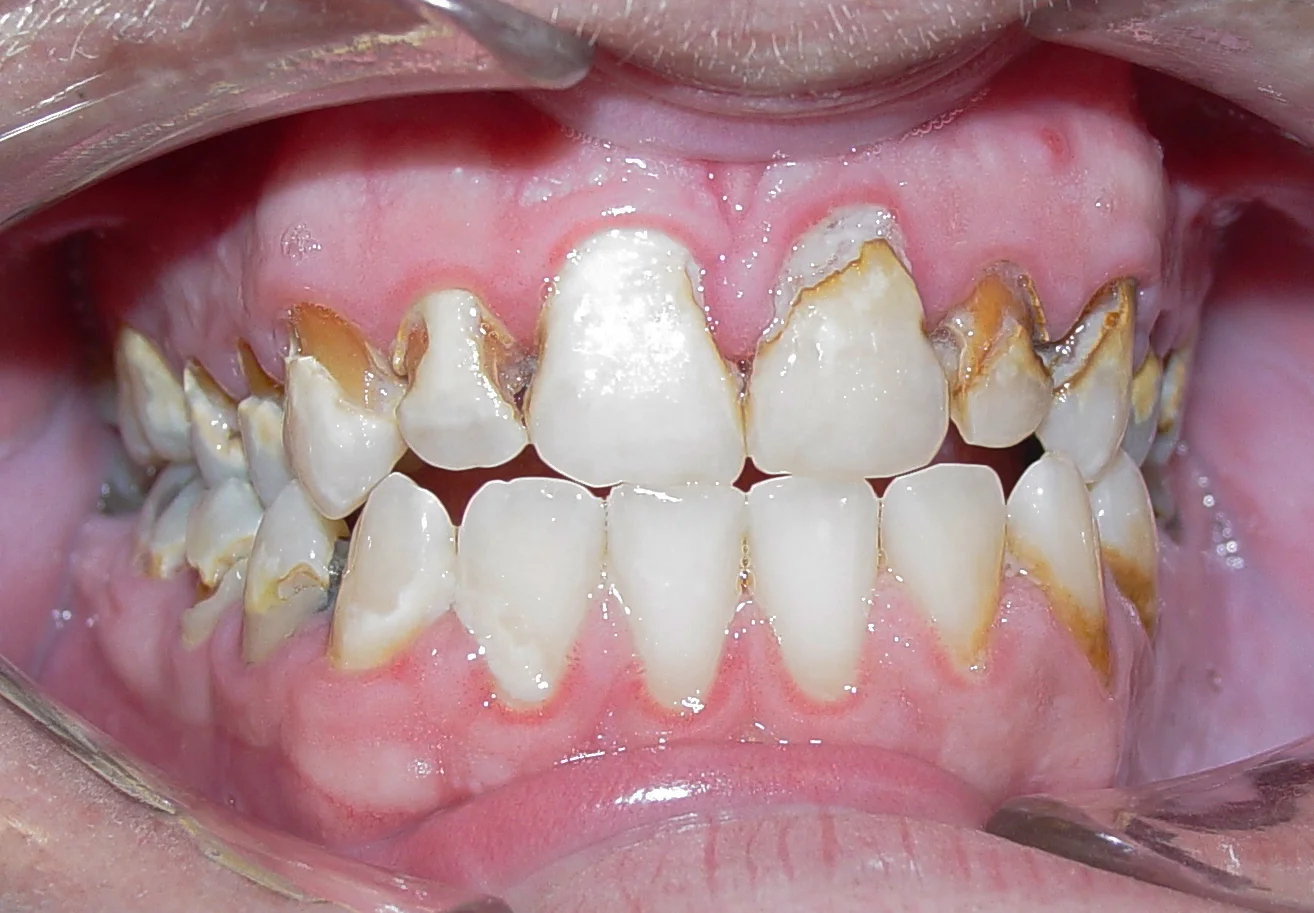 Before All maxillary (upper) teeth and most mandibular (lower) teeth presented with severe decay. Patient was young (20's) and desperately wanted to keep his teeth. Treatment involved several appointments of decay removal, root canals, periodontal (gum) surgery to lengthen his teeth, and the extraction of the second molars (non restorable, too much decay). All the maxillary teeth and mandibular posterior (back) teeth were prepared for aesthetic porcelain fused to metal crowns.