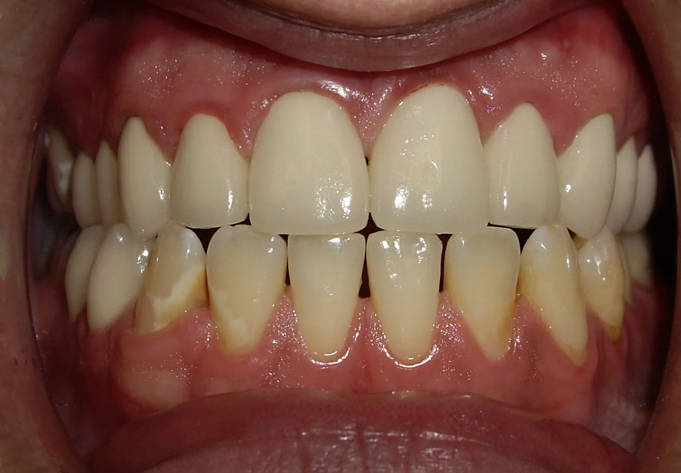 A fter The delivery of the crowns followed by dietetic counseling and a 3 month periodontal cleaning protocol. This picture was taken two years after the placement of the definitive aesthetic crown restorations, and he remains cavity free.