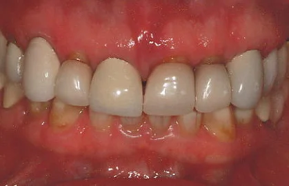Before treatment Patient experienced isolated periodontal bone loss to her upper right central incisor. Also noted were improperly shaped and ill fitting anterior crowns.