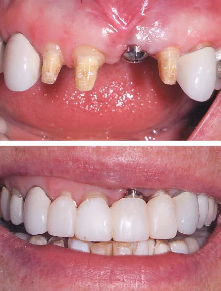 During treatment After the affected tooth was extracted and the dental implant was placed, a temporary cemented bridge was fabricated to avoid wearing anything removable during the course of treatment. Esthetic crown (gum) lengthening was performed on the incisors to allow a better match of the incisal crowns to the canines