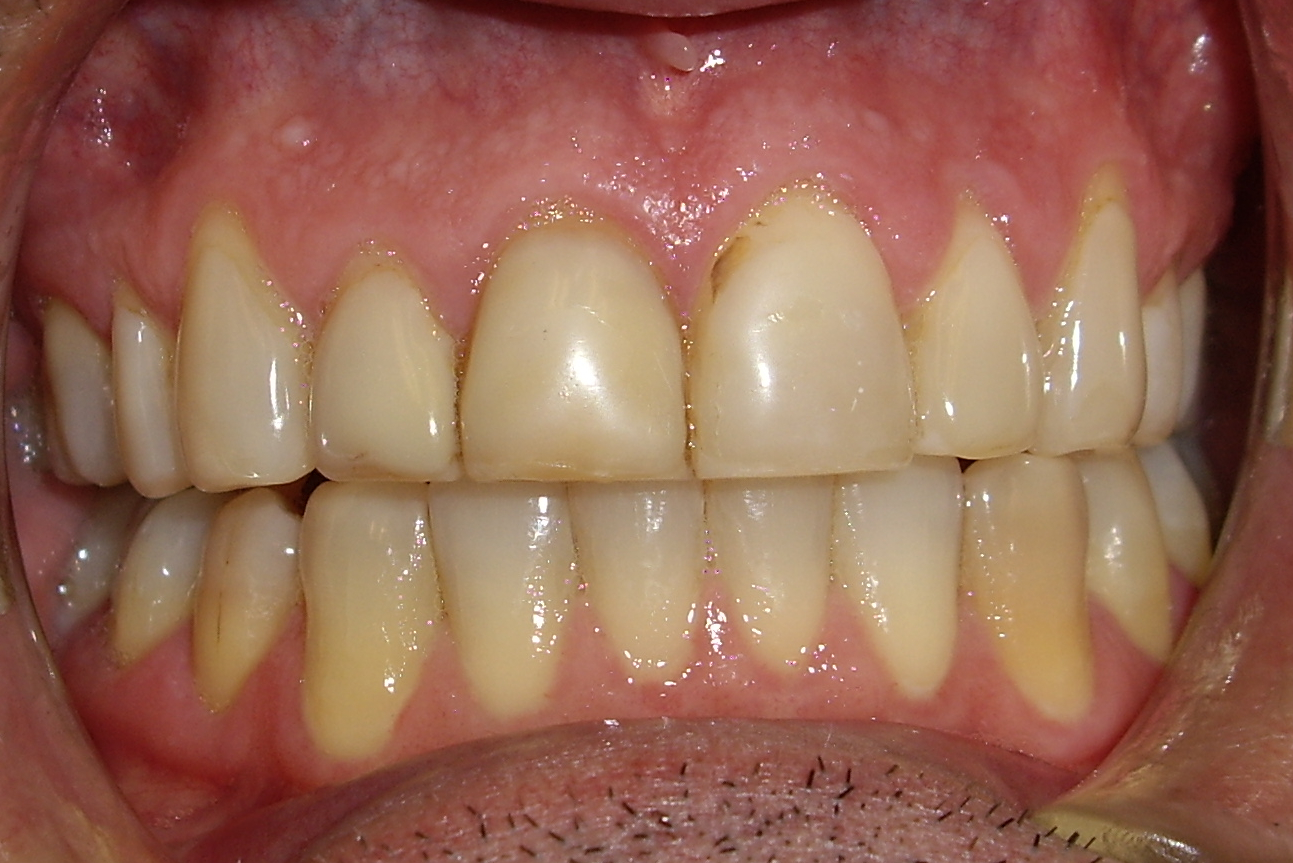 Before treatment Patient wished to have the shape and color of his teeth restored to their more youthful form.