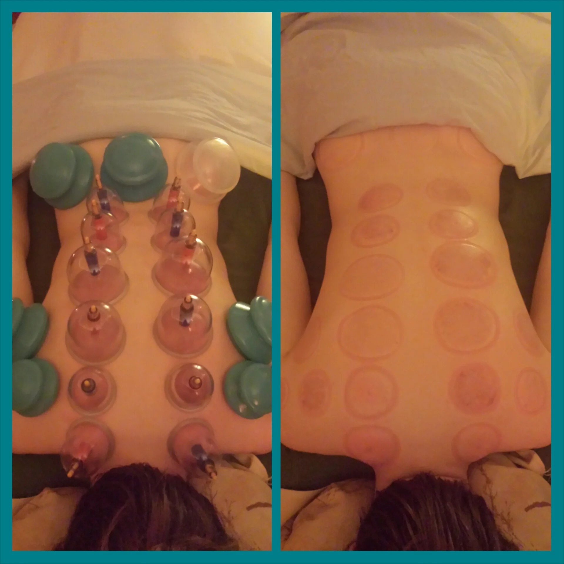 before and post-cupping