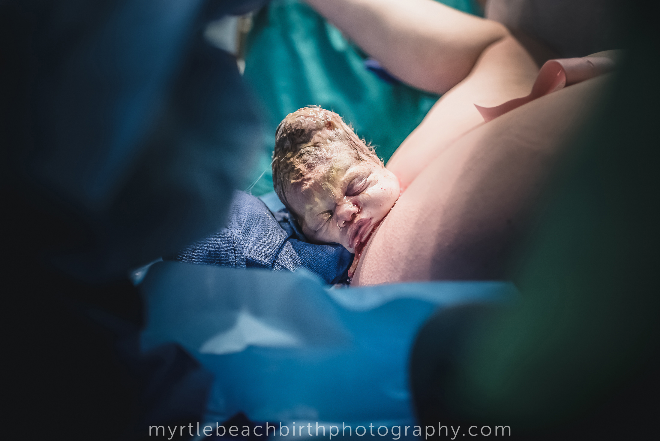 "This birth was such an amazing experience for me as a birth worker. The mother was a midwife and a good friend of mine. She conceived her baby via IVF after adopting embryos. After a rollercoaster of a labor, she finally began to push, and as baby emerged we realized she was not only completely OP (she has turned by the time I took this photo) but she was asynclitic - as evidenced by the super lopsided pointy little head. Of course her little noggin rounded out perfectly within a few hours, but I just find it so fascinating what our bodies and our baby's bodies are capable of during birth." Myrtle Beach Birth Photography