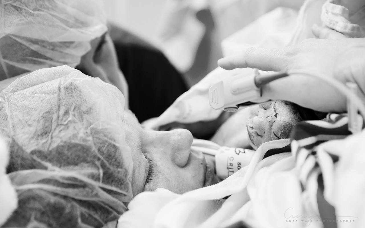 Planned repeat cesarean for mama whose baby had anencephaly. She waited until the right time to plan her cesarean so her baby could be born alive and donate organs. And that exact plan happened because of her cesarean. www.anyawait.com
